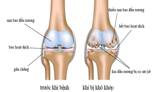 khô khớp gối