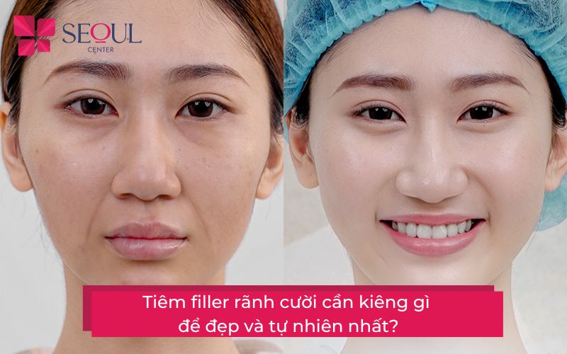 Tiêm filler rãnh cười cần kiêng gì để đẹp và tự nhiên nhất? - Seoul Center