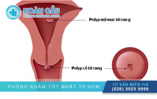 polyp-co-tu-cung-la-gi-1.jpg