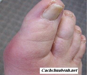 benh-gout.jpg