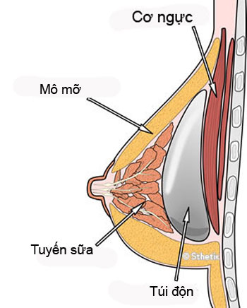 breast-implant-over-muscle-1830-1395898583.jpg