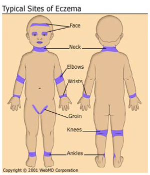 di-ung-eczema-lon-vn-3.jpg