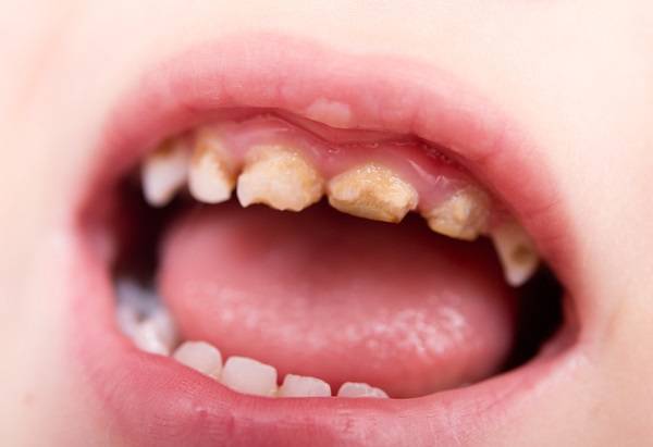 nguyên nhân răng sữa do vi khuẩn xâm nhập