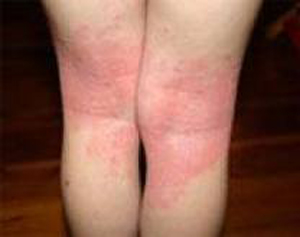 di-ung-eczema-lon-vn-2.jpg