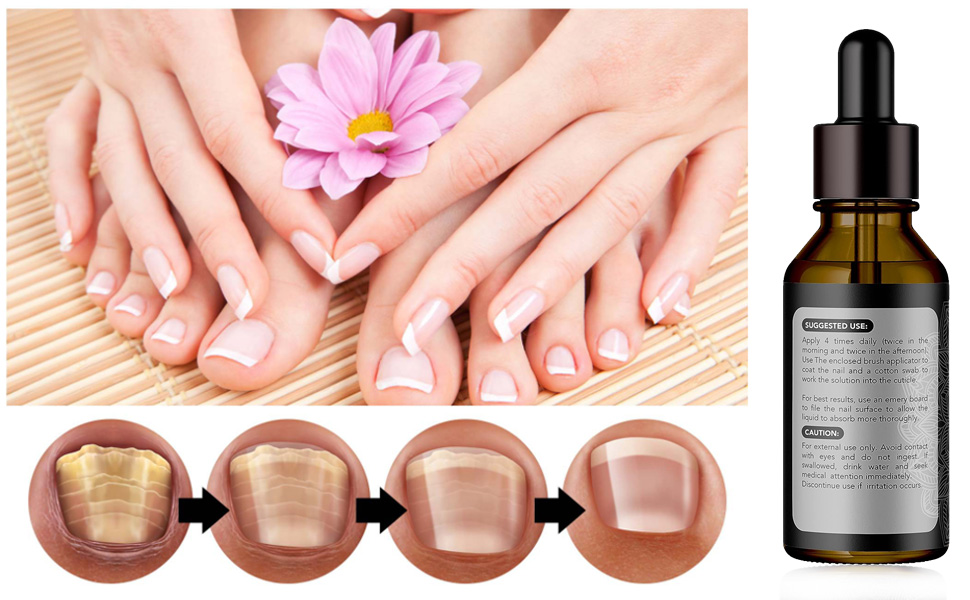 Amazon.com : Metanail Toenail Treatment Nail Growth Treatment for Toenail  Treatment Extra Strength for Repairing Damaged and Discolored Nails :  Beauty & Personal Care